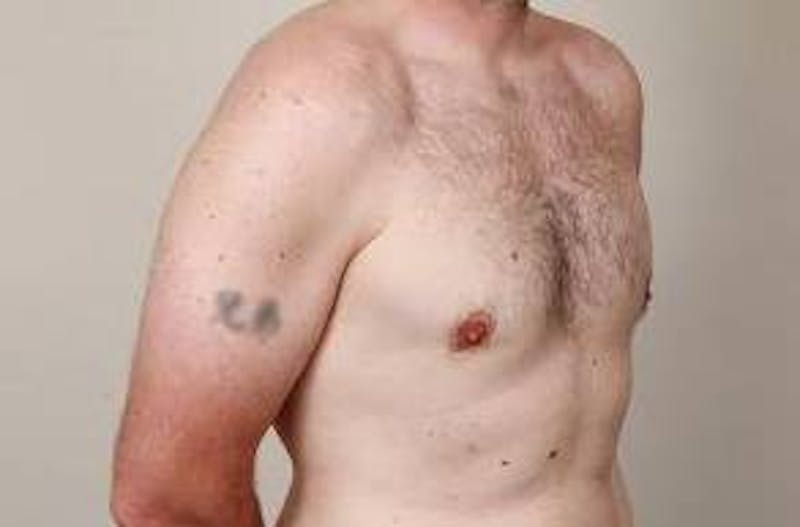 Male Breast Reduction Before & After Gallery - Patient 216761 - Image 8 - Scott Chapin, MD