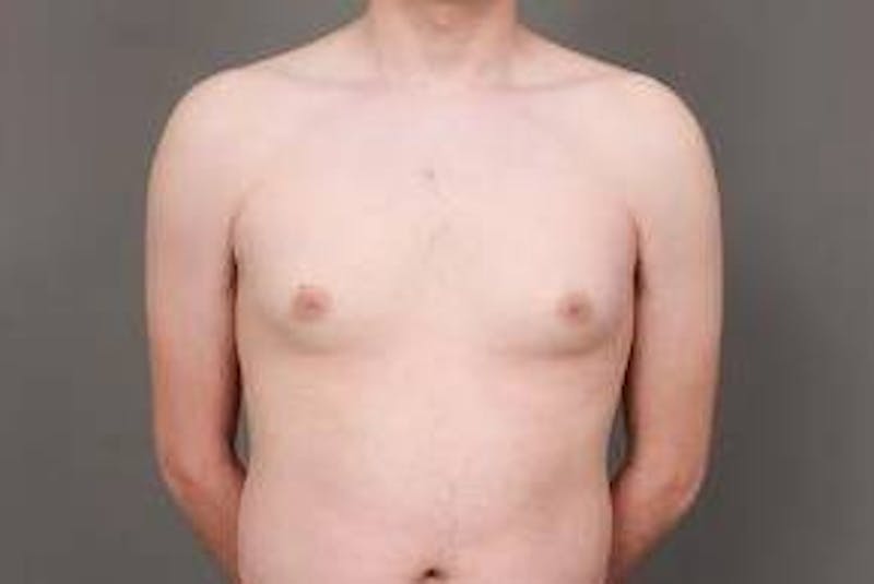 Male Breast Reduction Before & After Gallery - Patient 187043 - Image 1 - Scott Chapin, MD
