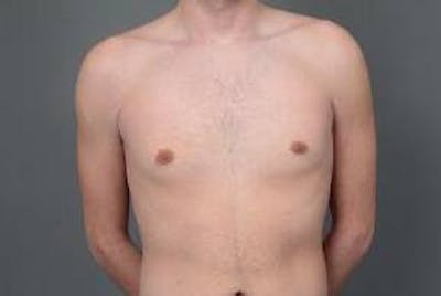 Male Breast Reduction Before & After Gallery - Patient 187043 - Image 2 - Scott Chapin, MD