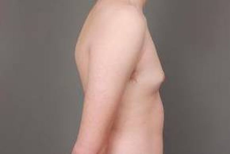 Male Breast Reduction Before & After Gallery - Patient 187043 - Image 3 - Scott Chapin, MD