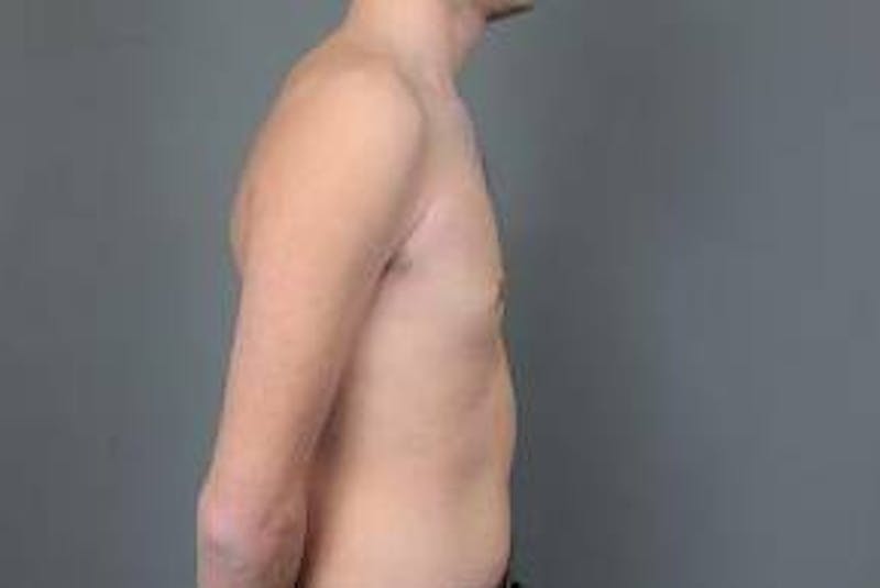 Male Breast Reduction Before & After Gallery - Patient 187043 - Image 4 - Scott Chapin, MD
