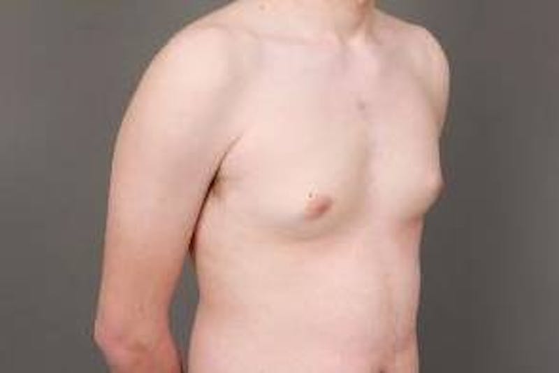 Male Breast Reduction Before & After Gallery - Patient 187043 - Image 5 - Scott Chapin, MD