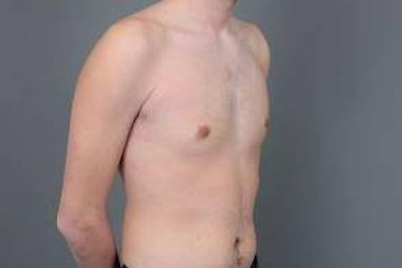 Male Breast Reduction Before & After Gallery - Patient 187043 - Image 6 - Scott Chapin, MD