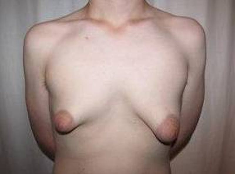 Male Breast Reduction Before & After Gallery - Patient 219483 - Image 1 - Scott Chapin, MD