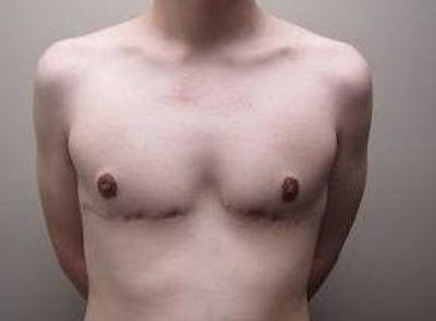 Male Breast Reduction Before & After Gallery - Patient 219483 - Image 2 - Scott Chapin, MD