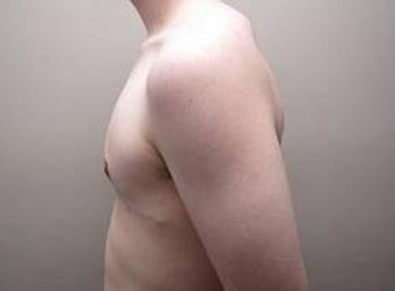 Male Breast Reduction Before & After Gallery - Patient 219483 - Image 4 - Scott Chapin, MD