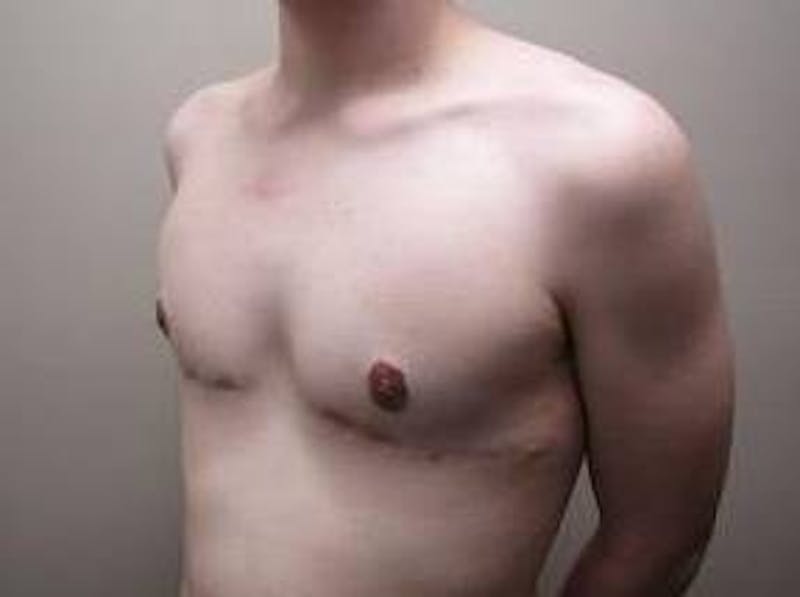 Male Breast Reduction Before & After Gallery - Patient 219483 - Image 6 - Scott Chapin, MD