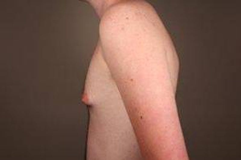 Male Breast Reduction Before & After Gallery - Patient 434952 - Image 1 - Scott Chapin, MD