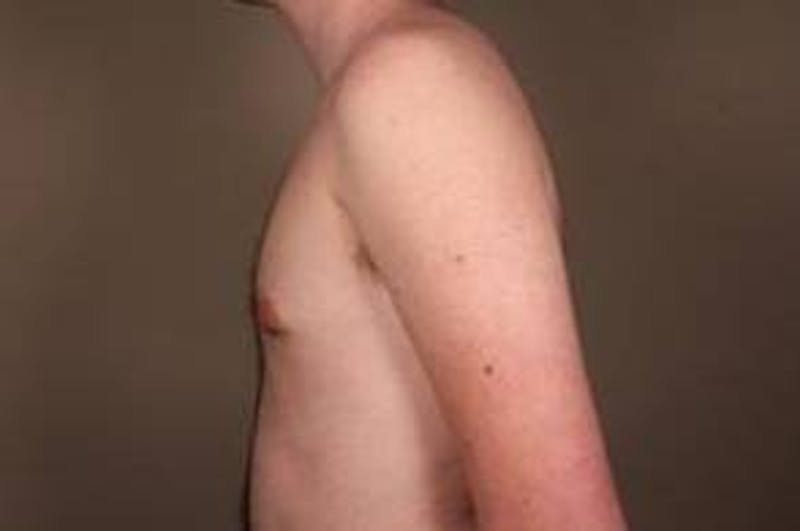Male Breast Reduction Before & After Gallery - Patient 434952 - Image 2 - Scott Chapin, MD