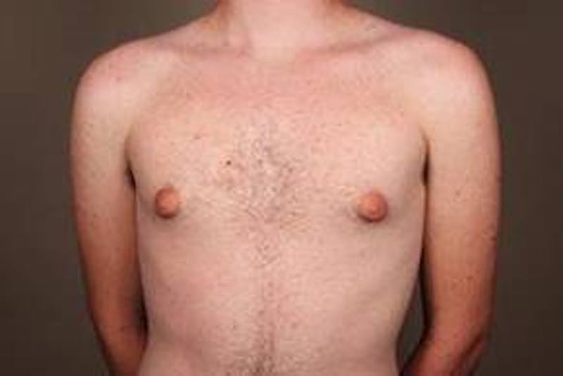 Male Breast Reduction Before & After Gallery - Patient 434952 - Image 3 - Scott Chapin, MD