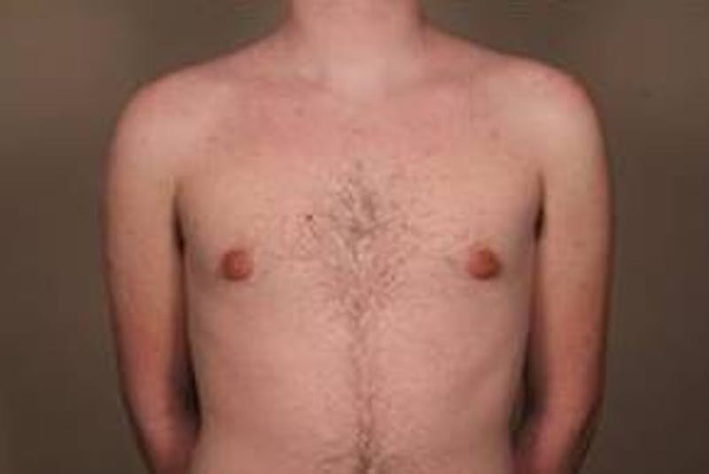 Male Breast Reduction Before & After Gallery - Patient 434952 - Image 4 - Scott Chapin, MD