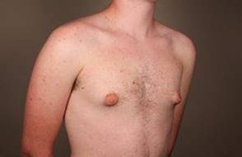 Male Breast Reduction Before & After Gallery - Patient 434952 - Image 5 - Scott Chapin, MD