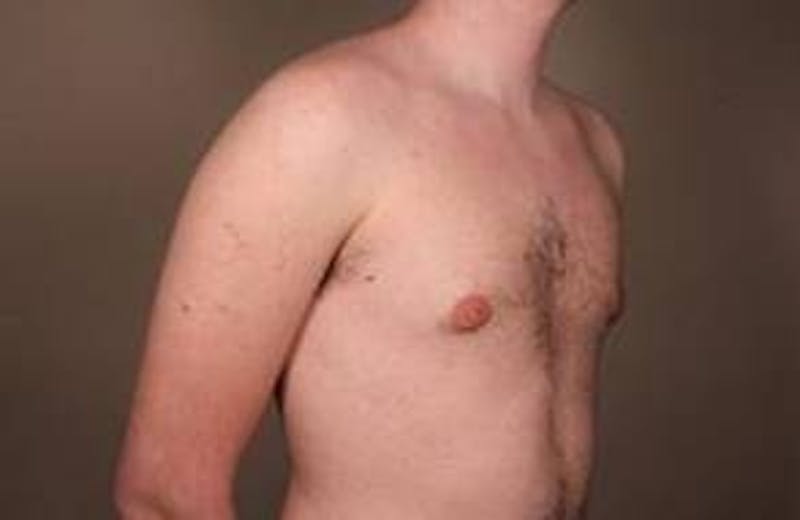 Male Breast Reduction Before & After Gallery - Patient 434952 - Image 6 - Scott Chapin, MD