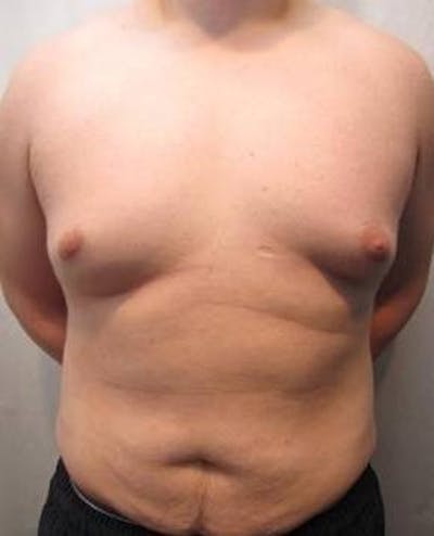 Male Tummy Tuck Before & After Gallery - Patient 206757 - Image 1 - Scott Chapin, MD