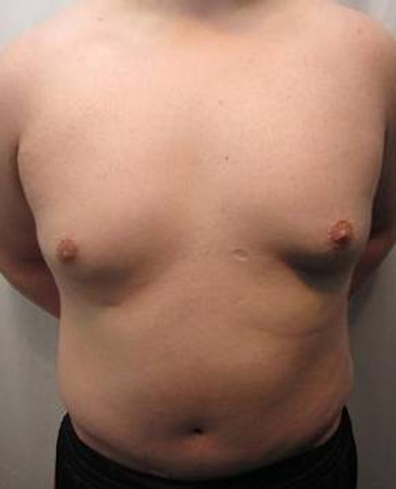 Male Tummy Tuck Before & After Gallery - Patient 206757 - Image 2 - Scott Chapin, MD