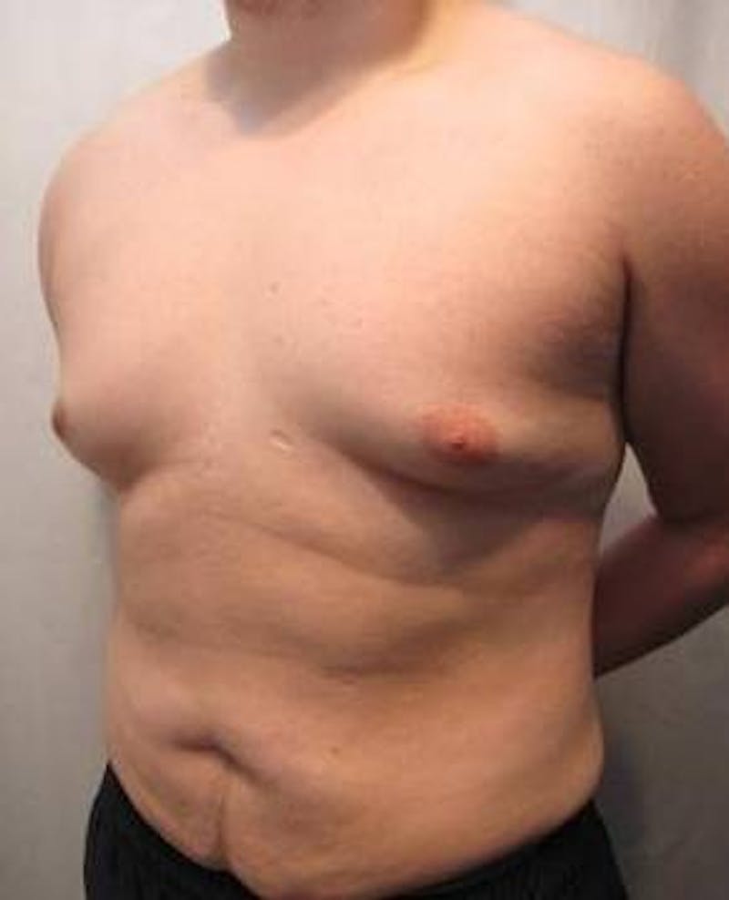 Male Tummy Tuck Before & After Gallery - Patient 206757 - Image 3 - Scott Chapin, MD