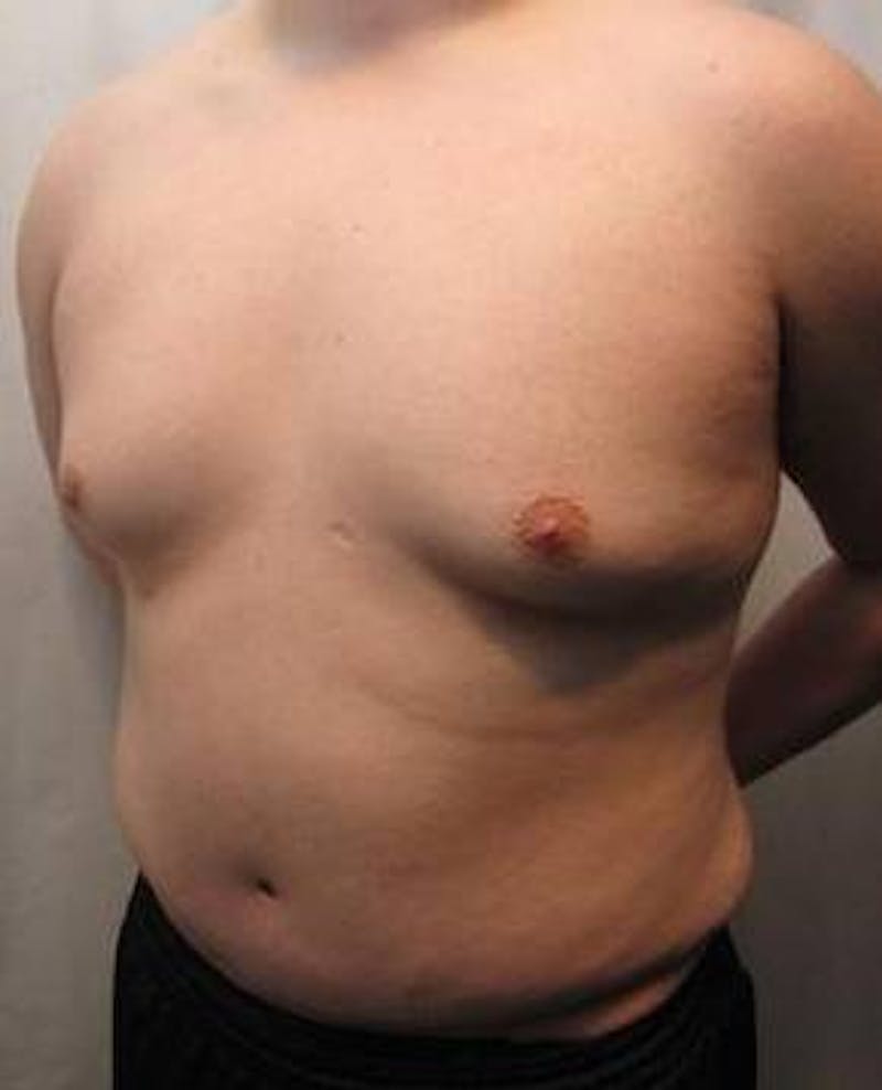 Male Tummy Tuck Before & After Gallery - Patient 206757 - Image 4 - Scott Chapin, MD
