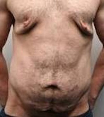 Male Tummy Tuck Before & After Gallery - Patient 369096 - Image 1 - Scott Chapin, MD