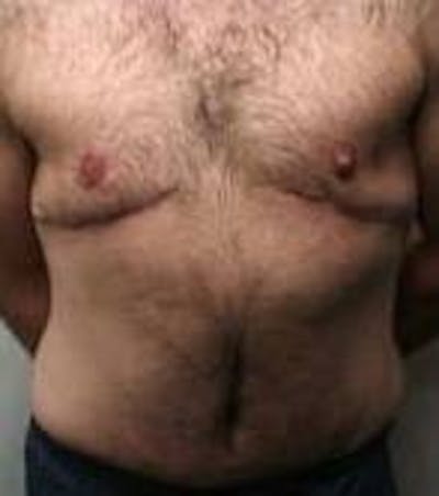 Male Tummy Tuck Before & After Gallery - Patient 369096 - Image 2 - Scott Chapin, MD