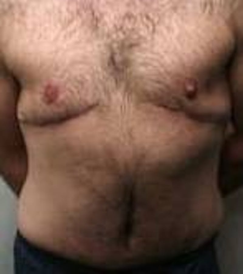Male Tummy Tuck Before & After Gallery - Patient 369096 - Image 2 - Scott Chapin, MD