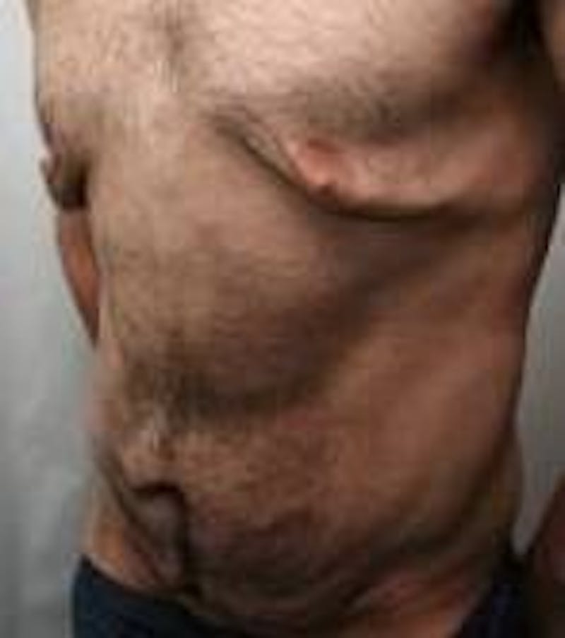 Male Tummy Tuck Before & After Gallery - Patient 369096 - Image 5 - Scott Chapin, MD