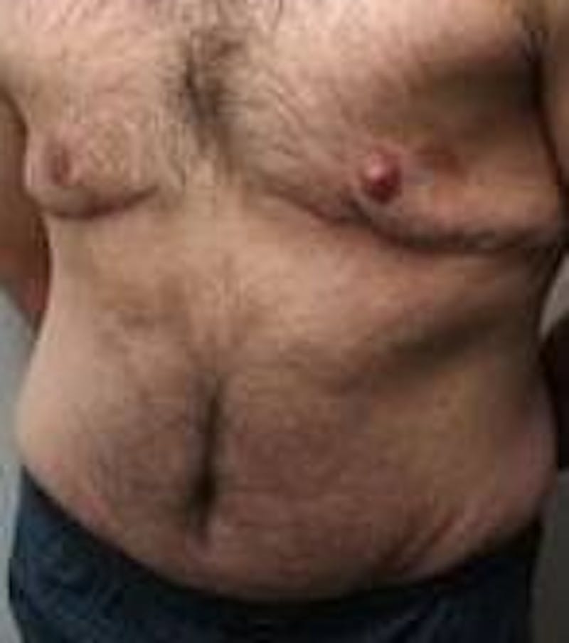 Male Tummy Tuck Before & After Gallery - Patient 369096 - Image 6 - Scott Chapin, MD