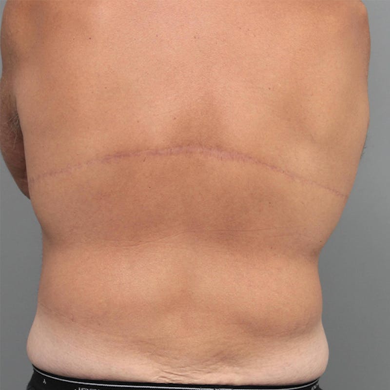 Male Liposuction Before & After Gallery - Patient 117644 - Image 1 - Scott Chapin, MD