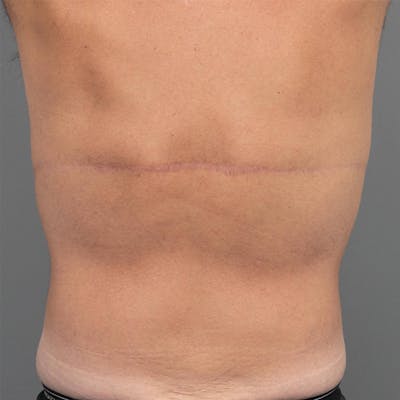 Male Liposuction Before & After Gallery - Patient 117644 - Image 2 - Scott Chapin, MD