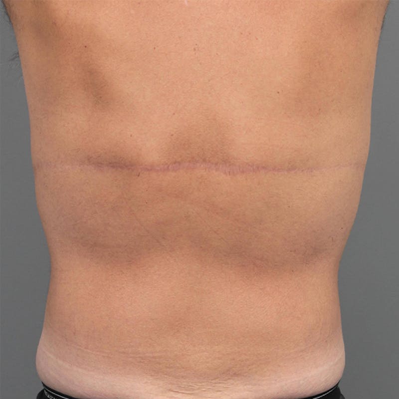 Male Liposuction Before & After Gallery - Patient 117644 - Image 2 - Scott Chapin, MD