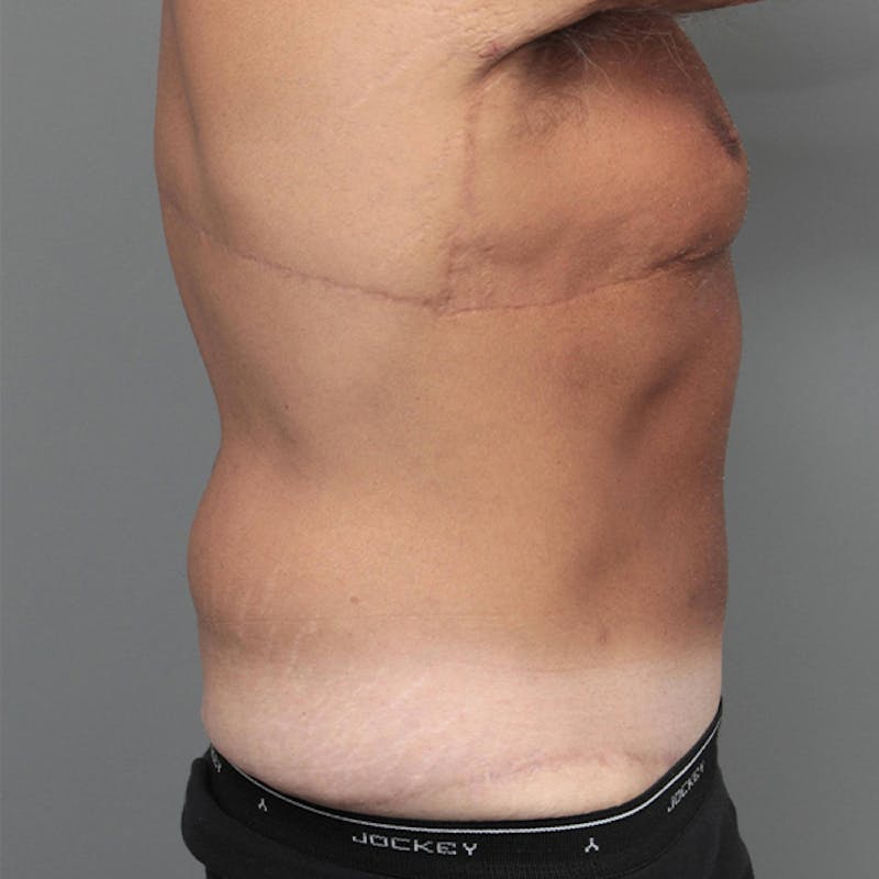 Male Liposuction Before & After Gallery - Patient 117644 - Image 3 - Scott Chapin, MD