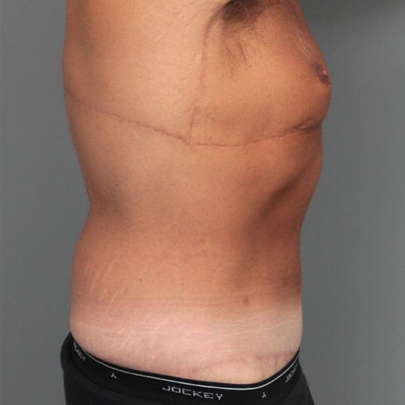 Male Liposuction Before & After Gallery - Patient 117644 - Image 4 - Scott Chapin, MD