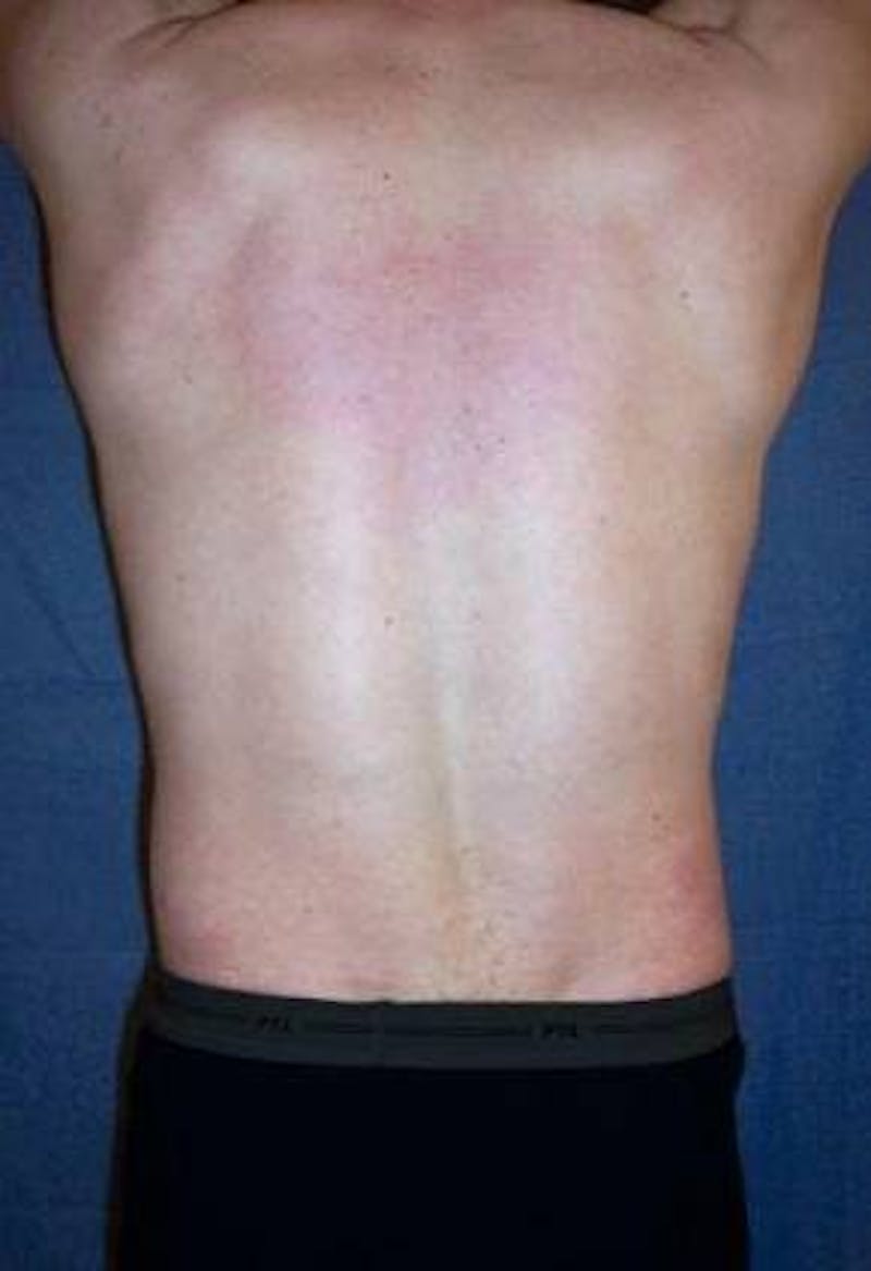 Male Liposuction Before & After Gallery - Patient 414417 - Image 1 - Scott Chapin, MD