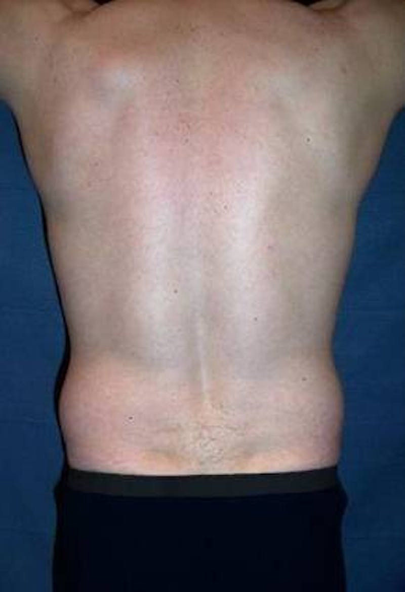 Male Liposuction Before & After Gallery - Patient 414417 - Image 2 - Scott Chapin, MD