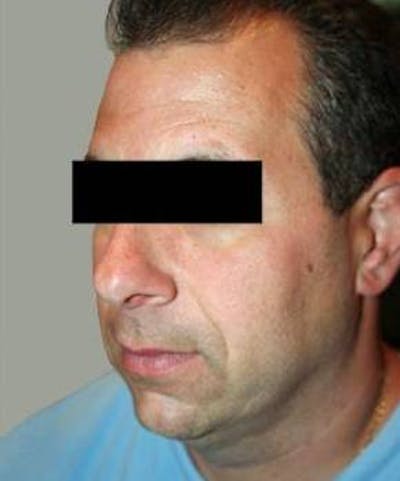 Male Neck Contouring Before & After Gallery - Patient 943038 - Image 2 - Scott Chapin, MD