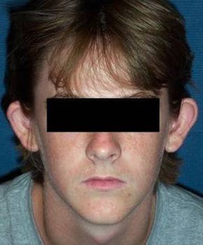 Male Ear Surgery Before & After Gallery - Patient 409896 - Image 1 - Scott Chapin, MD