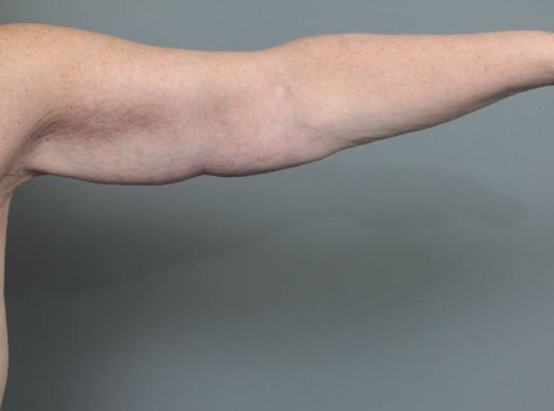Arm Lift Before & After Gallery - Patient 381179 - Image 2 - Scott Chapin, MD