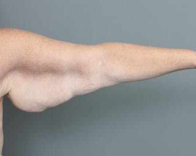 Arm Lift Before & After Gallery - Patient 381179 - Image 1 - Scott Chapin, MD