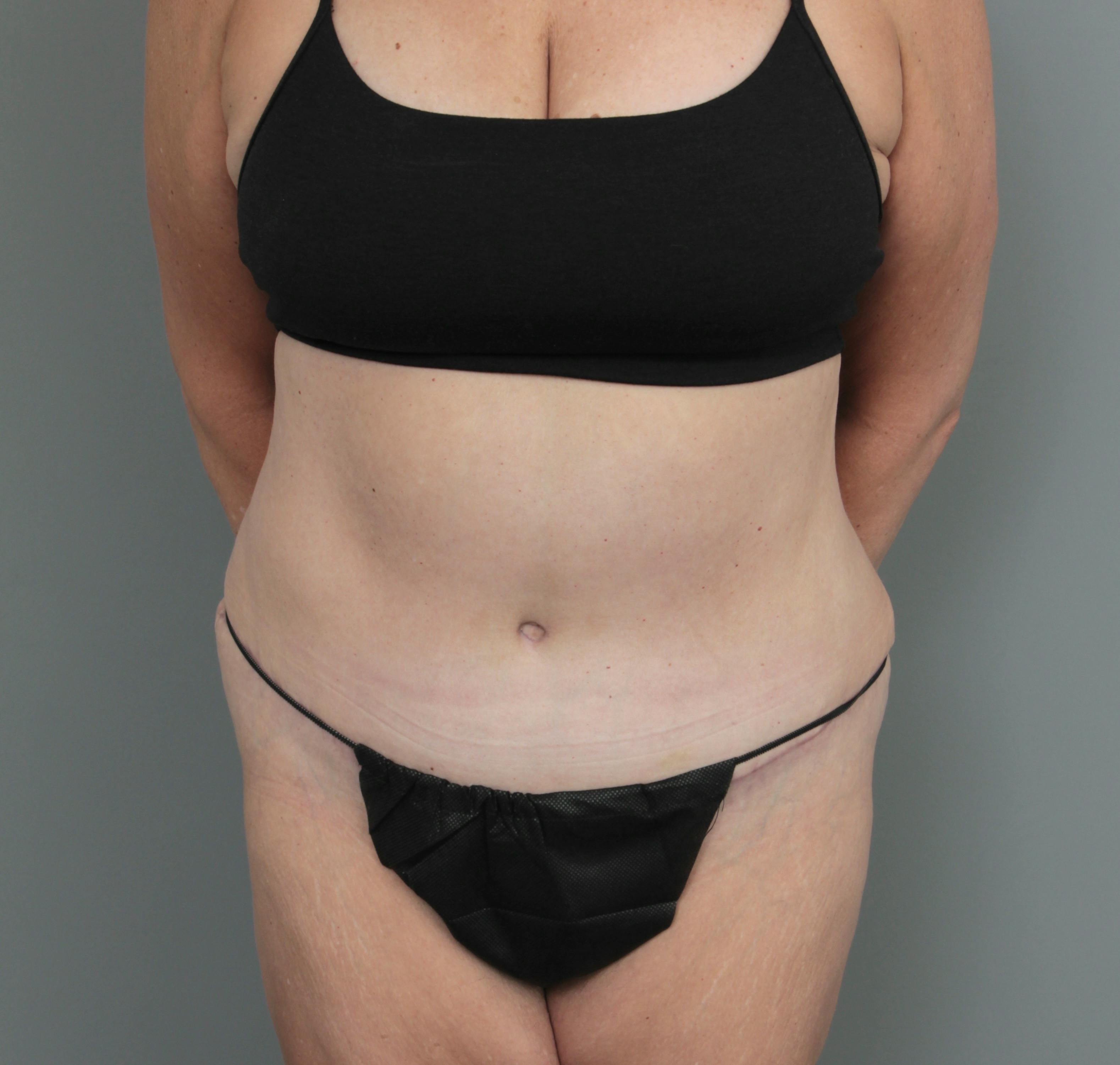 Liposuction of the abdomen