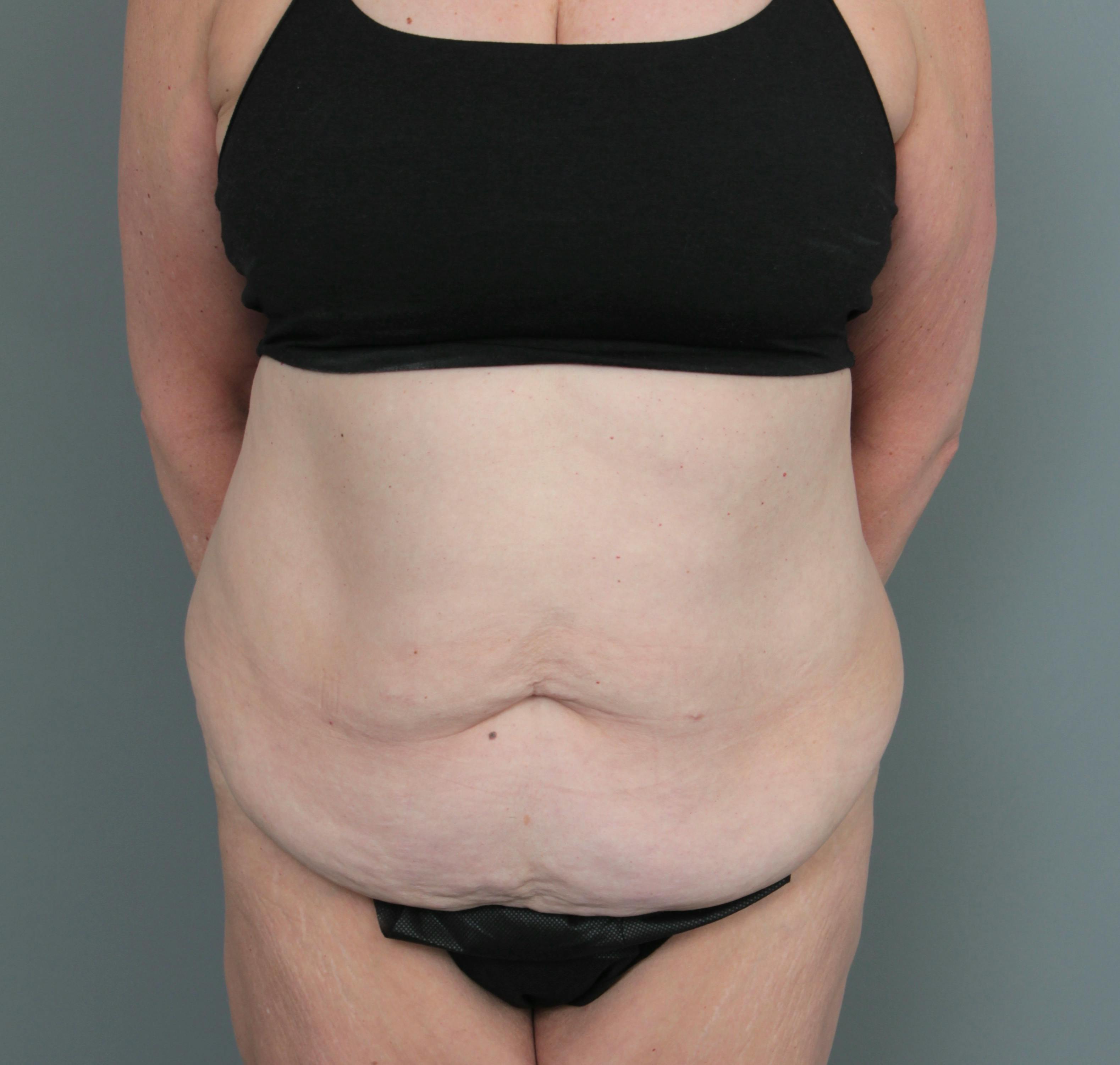 Liposuction of the abdomen