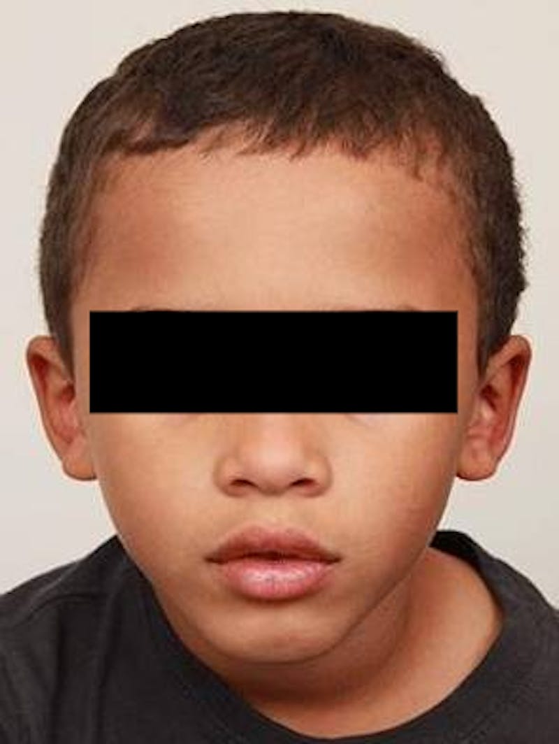 Ear Surgery Before & After Gallery - Patient 129772 - Image 2 - Scott Chapin, MD