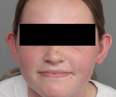 Ear Surgery Before & After Gallery - Patient 183139 - Image 1 - Scott Chapin, MD