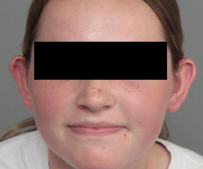 Ear Surgery Before & After Gallery - Patient 183139 - Image 1 - Scott Chapin, MD