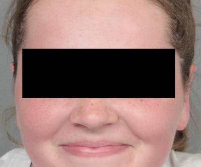 Ear Surgery Before & After Gallery - Patient 183139 - Image 2 - Scott Chapin, MD