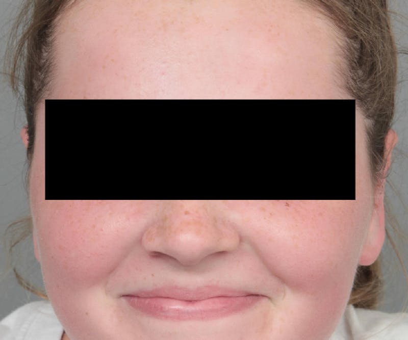 Ear Surgery Before & After Gallery - Patient 183139 - Image 2 - Scott Chapin, MD