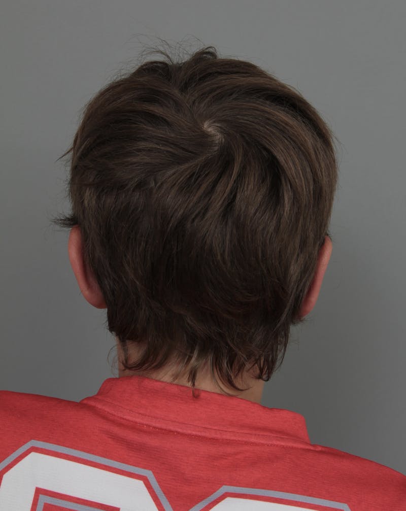 Ear Surgery Before & After Gallery - Patient 321850 - Image 4 - Scott Chapin, MD