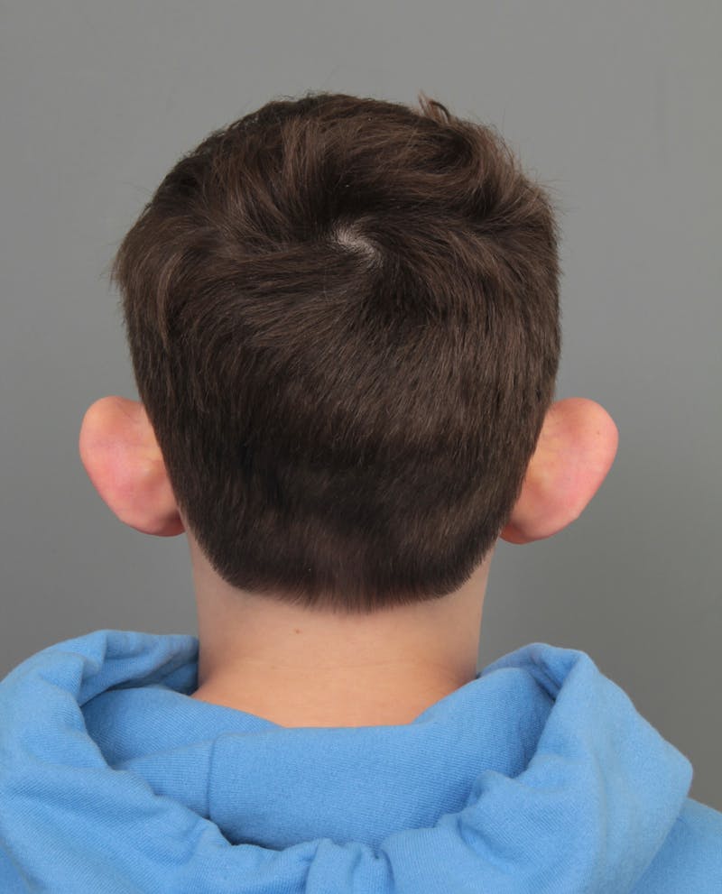 Ear Surgery Before & After Gallery - Patient 321850 - Image 3 - Scott Chapin, MD