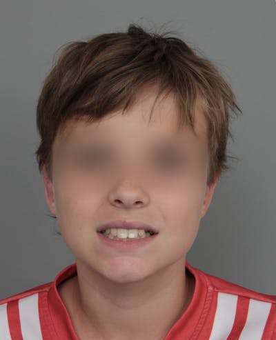 Ear Surgery Before & After Gallery - Patient 321850 - Image 2 - Scott Chapin, MD