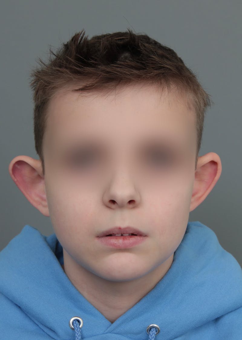Ear Surgery Before & After Gallery - Patient 321850 - Image 1 - Scott Chapin, MD