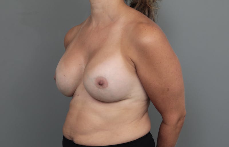 Breast Revision Before & After Gallery - Patient 362987 - Image 4 - Scott Chapin, MD
