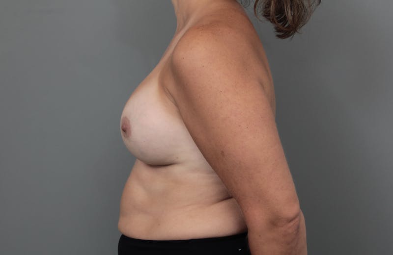 Breast Revision Before & After Gallery - Patient 362987 - Image 6 - Scott Chapin, MD